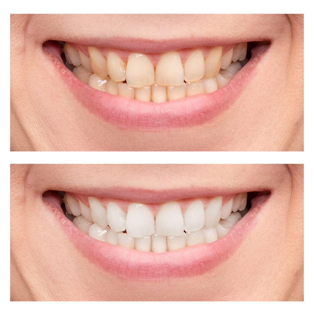 Best Teeth Whitening in Saint John