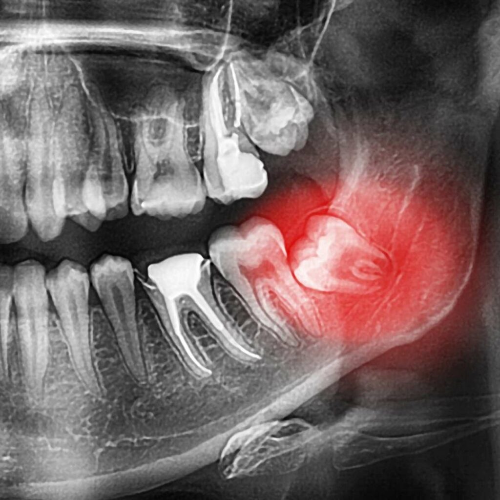 Wisdom teeth extraction in Saint John