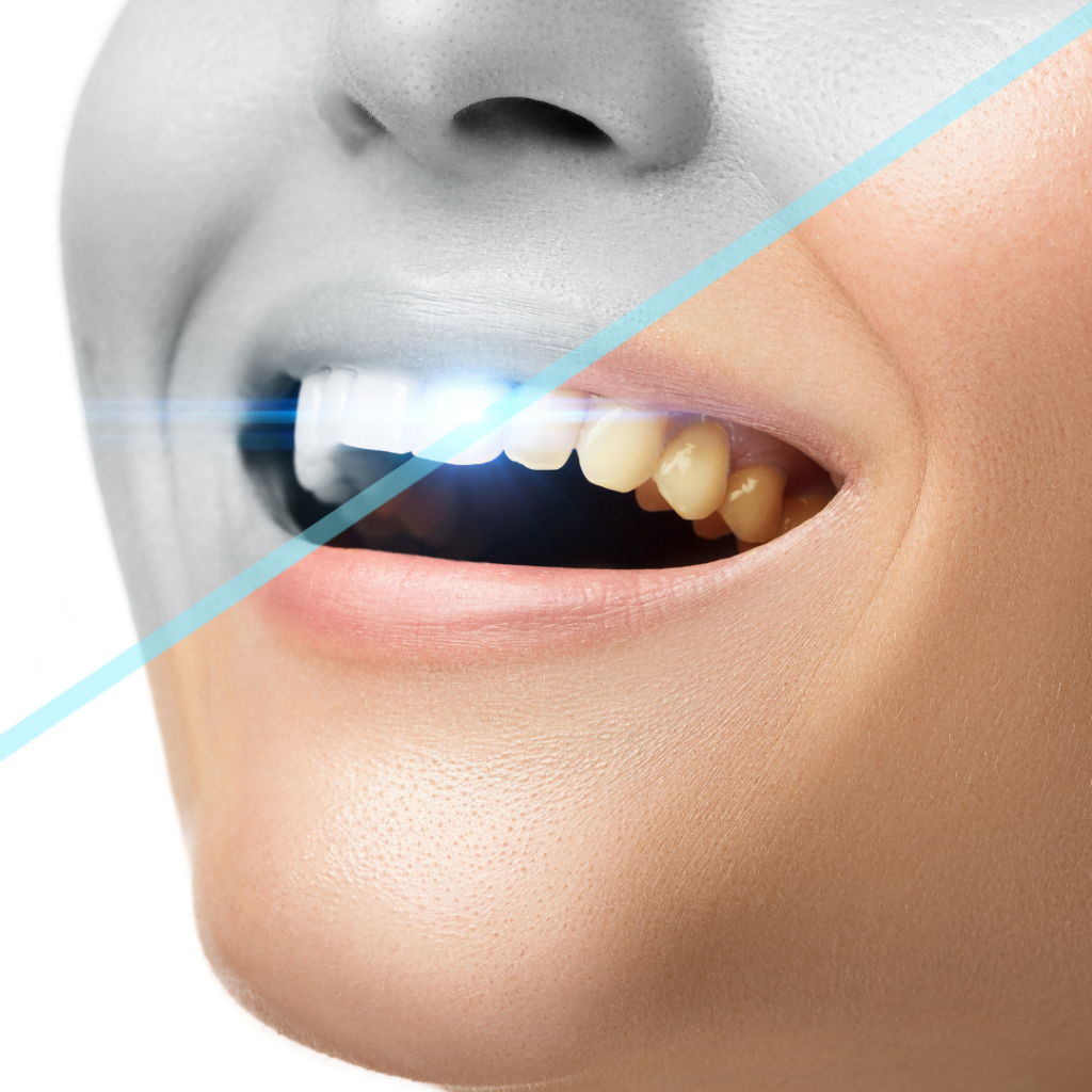 Teeth Whitening Before and After